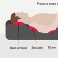 Preventing hospital-acquired pressure ulcers: A case study about system innovations in healthcare