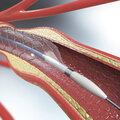 New catheter technology promises safer and more efficient treatment of blood vessels