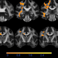 Paper Lena Filatova published in Radiology: "White Matter by Diffusion MRI Following Methylphenidate Treatment: A Randomized Control Trial in Males with Attention-Deficit/Hyperactivity Disorder"